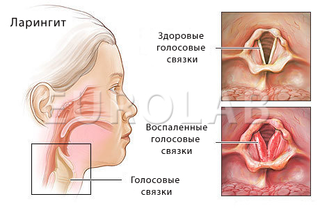 Сухость в горле в домашних условиях Сухость в горле в домашних условиях