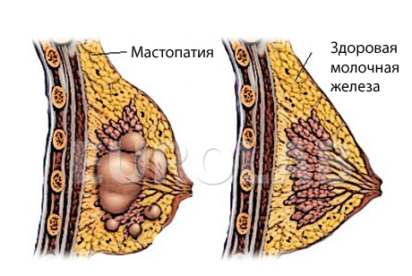 Мастопатия