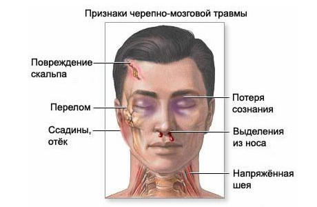 Травма черепа и головного мозга