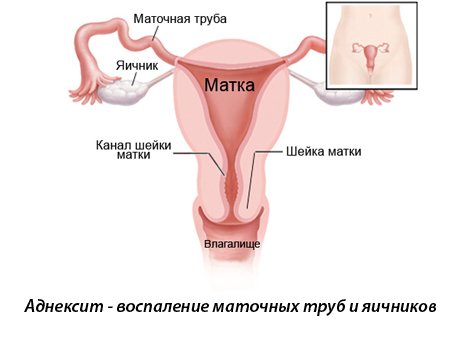 Воспаление по гинекологии признаки