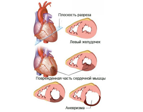 Аневризма мпп сердца у взрослого что. anevrisma. Аневризма мпп сердца у взрослого что фото. Аневризма мпп сердца у взрослого что-anevrisma. картинка Аневризма мпп сердца у взрослого что. картинка anevrisma