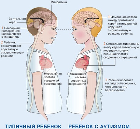 Реферат: Симптомы аутизма