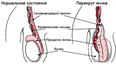 Перекрут яичка