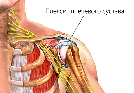 плексит плечевого сустава