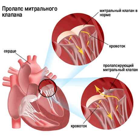 Пролапс митрального клапана у детей