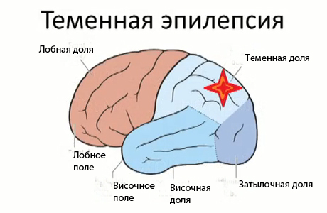 теменная эпилепсия у детей