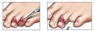 Ампутация части пальца на ноге