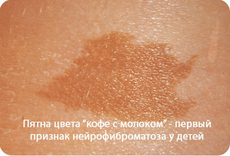 Грибок ногтей на ногах лечить лучше