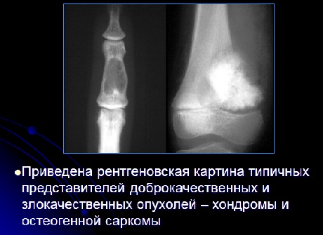 Реферат по травматологии опухоли костей 9778