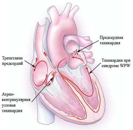 Пароксизмальная тахикардия у детей