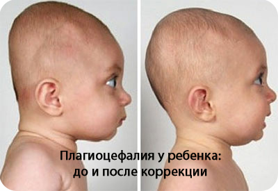 Краниостеноз что это такое. Смотреть фото Краниостеноз что это такое. Смотреть картинку Краниостеноз что это такое. Картинка про Краниостеноз что это такое. Фото Краниостеноз что это такое