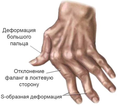 Поражение руки при ревматоидном артрите