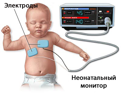 Синдром внезапной смерти у детей