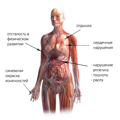 синдром вегетативной дистонии