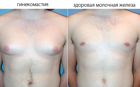 Гинекомастия гинекомастия