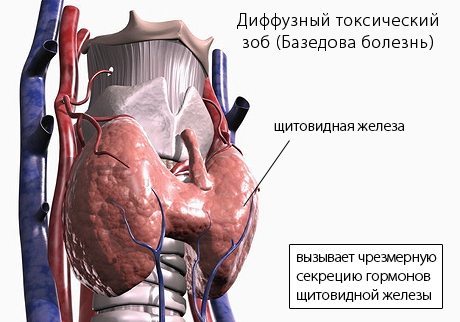 базедова болезнь