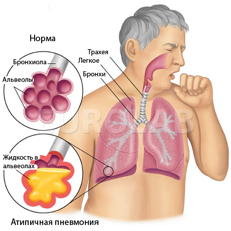 атипичная пневмония