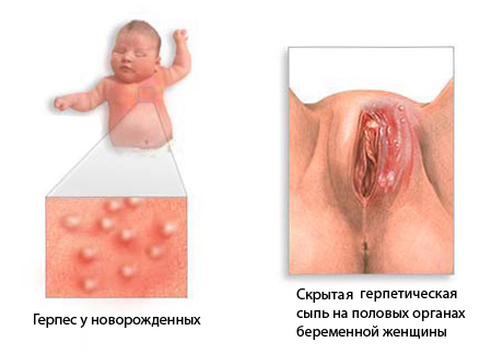 герпетическая инфекция у новорожденного