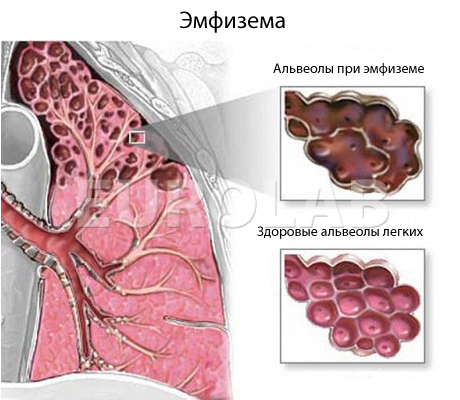Народные рецепты эмфизема легких. emfizema. Народные рецепты эмфизема легких фото. Народные рецепты эмфизема легких-emfizema. картинка Народные рецепты эмфизема легких. картинка emfizema. факторы, нарушающие эластичность и прочность элементов структуры легких