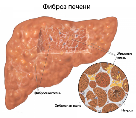 Как болит грудной остеохондроз упражнения