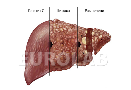 Гепатит С у детей