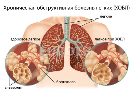 Как вылечить язву на ногах