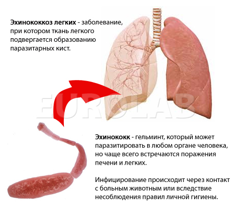 паразиты в легких человека лечение паразиты в легких человека лечение