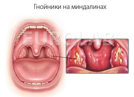 Как Выглядит Гнойная Ангина Фото