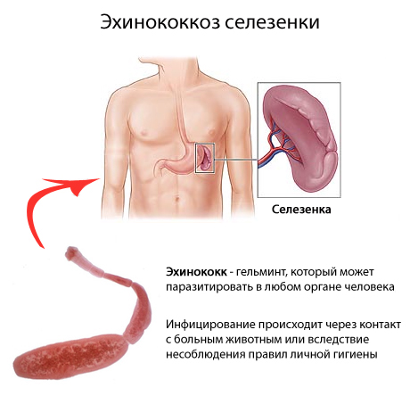 Болит селезёнка симптомы лечение в домашних условиях 296