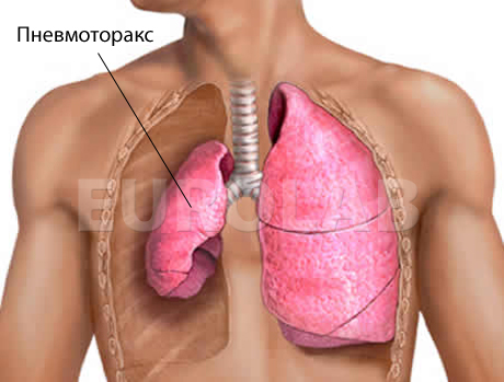 Пневмоторакс может возникнуть при травме грудной клетки
