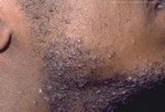 Люди с кучерявыми волосами часто страдают от бритвенных шишек.
Бритвенные шишки.
Бритвенные шишки – маленькие, воспаляющиеся шишки, которые развиваются после бритья. Острый край сбритого кучерявого волоска может закрутиться и врасти в кожу, тем самым создавая дискомфорт и появление шишек и даже рубцы. Чтобы снизить вероятность появления шишек, перед бритьем хорошо распарьте кожу, бриться лучше в направлении роста волос, не растягивайте кожу во время бритья. После бритья умывайтесь прохладной водой и используйте увлажнитель.