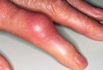 Подагра на пальцах рук.
Отложение кристаллов мочевой кислоты может встречаться на суставах пальцев рук. Чтобы облегчить боль во время приступа подагры, необходим отдых пораженным местам.