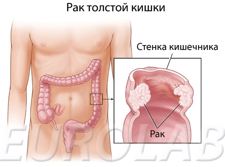 Рак Толстой Кишки Фото