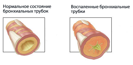 Бронхиальная астма у детей - симптомы болезни, профилактика и лечение Бронхиальной астмы у детей, причины заболевания и его диагностика на EUROLAB Бронхиальная астма у детей - симптомы болезни, профилактика и лечение Бронхиальной астмы у детей, причины заболевания и его диагностика на EUROLAB