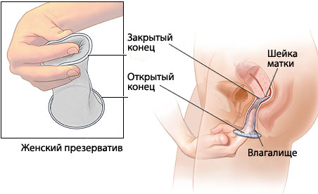 Женский Презерватив Инструкция