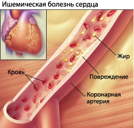 Ухудшается зрения и болит голова
