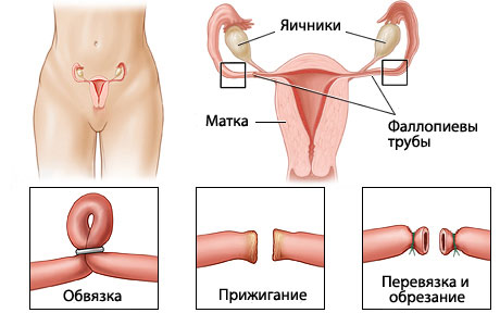 Где Находятся Маточные Трубы Фото