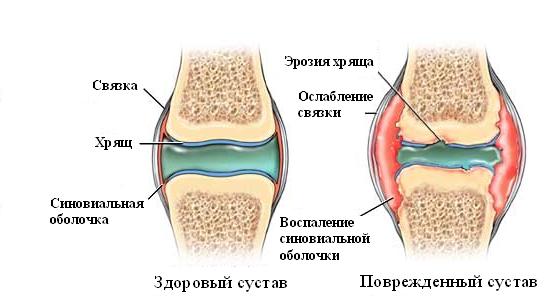 ревматоїдний артрит