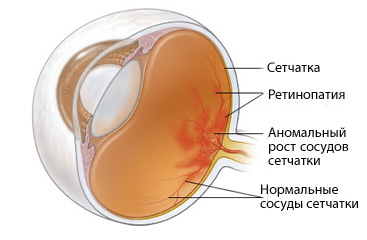 http://www.eurolab.ua/img/st_img/06_09/eye_diabet.jpg