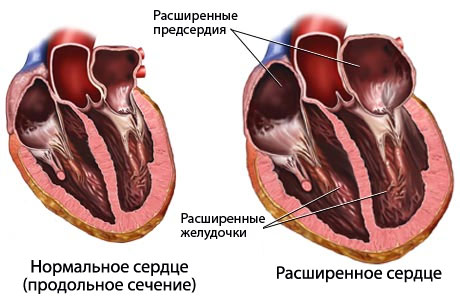 сердечная недостаточность