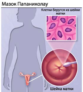 dumayu chto papillomi virus kak analiz na beretsya lenyu Как берется анализ на вирус папилломы фото