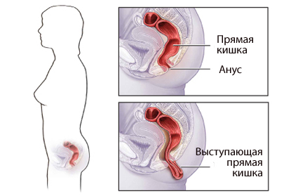 Выпадение прямой кишки