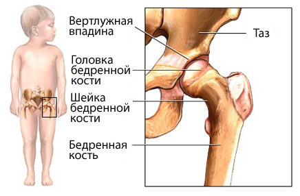 Тазобедренный сустав у детей