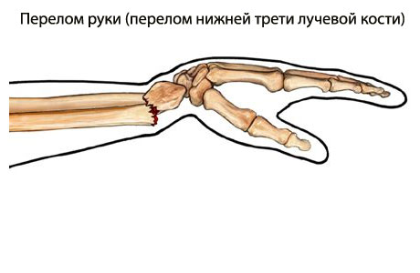 Перелом кости