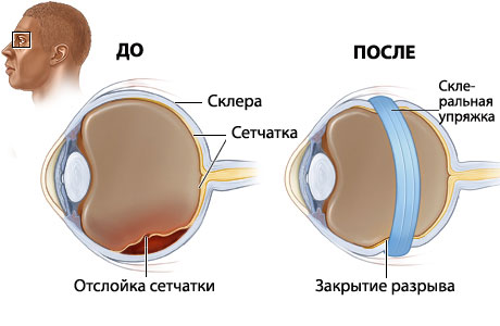 Глазное давление самолет