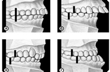 Виды прикуса