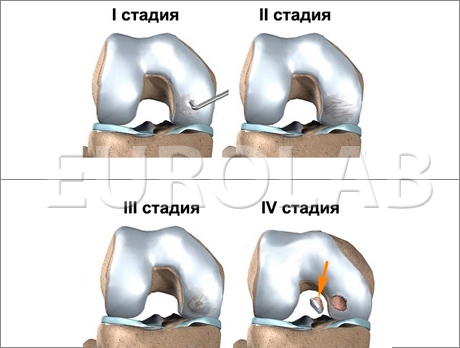 болезнь Кенига