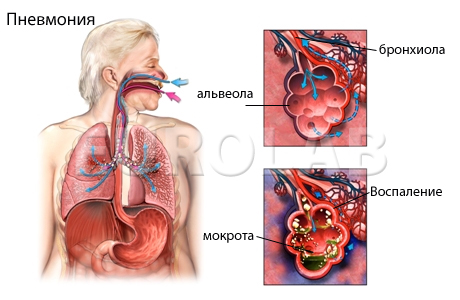 пневмония