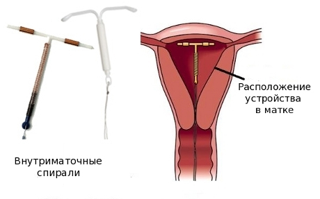 внутриматочная спираль