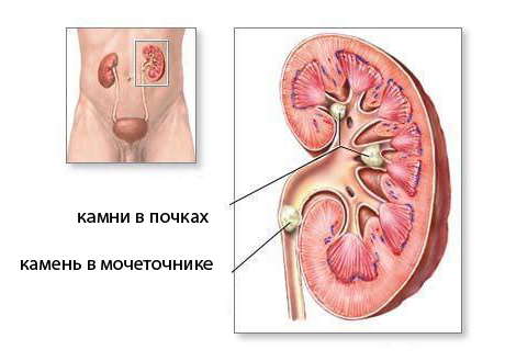 Народные средства лечения анурии Народные средства лечения анурии thumbnail
